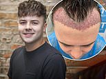 Luke Horsfield left with severe scarring after £1,250 botched hair transplant surgery