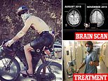 Man who has a toxic black fungus growing on his brain – among 120 diagnosed with rare condition