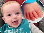 Mother warns of rare hair tourniquet syndrome after her five-month-old son nearly lost his toe