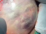 Fascinating footage shows baby’s face moving around inside amniotic sac during a C-section